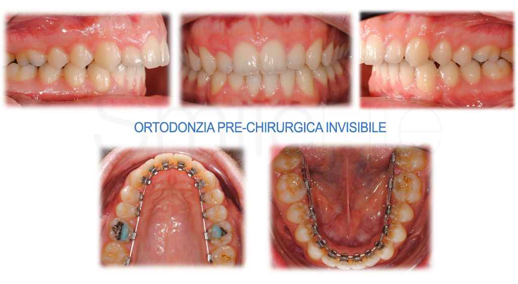 //www.molinarismilelife.it/wp-content/uploads/2016/04/ortodonzia-prechirurgica-invisibile-camilla-molinari-smilelife.jpg